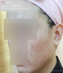 치료 후