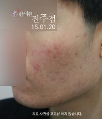 치료 후