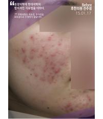 치료 전