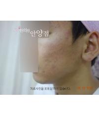치료 후
