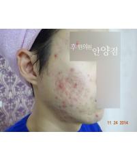 치료 전