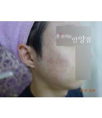 치료 후