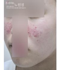 치료 전