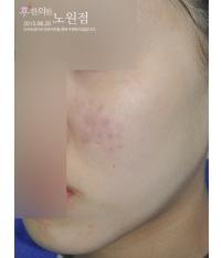 치료 후