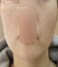 치료 후