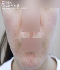치료 후
