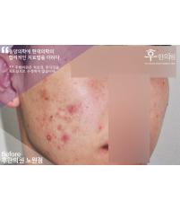 치료 전