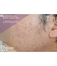 치료 후