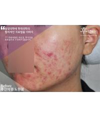 치료 전
