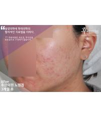 치료 후