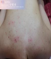 치료 전