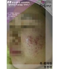 치료 전