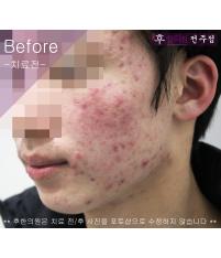 치료 전