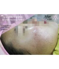 치료 후