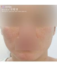 치료 전