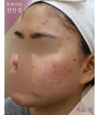 치료 전