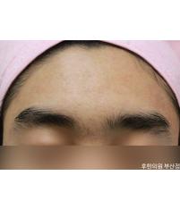 치료 후