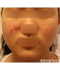 치료 전