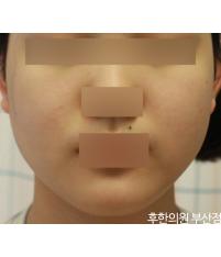 치료 후