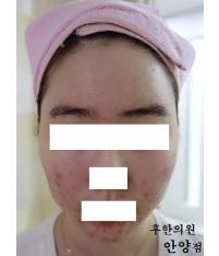 치료 전