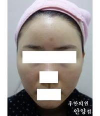 치료 후