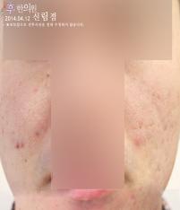 치료 전