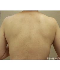 치료 후