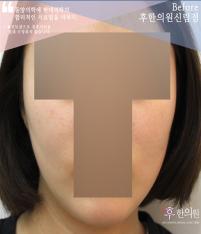 치료 전