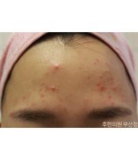 치료 전