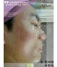 치료 후