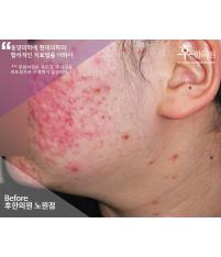 치료 전