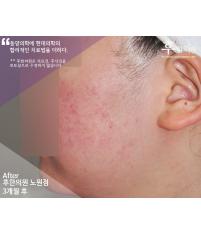 치료 후