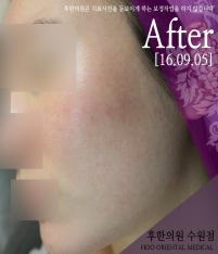 치료 후