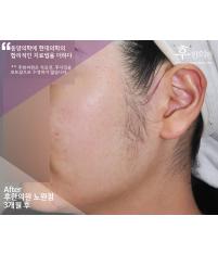 치료 후