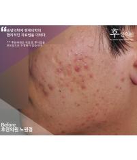 치료 전