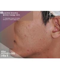 치료 후