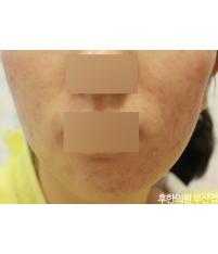 치료 후