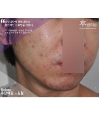 치료 전