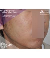 치료 후