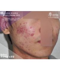 치료 전