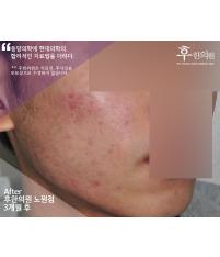 치료 후