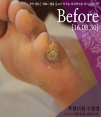 치료 전
