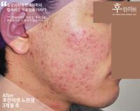 치료 후
