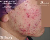 치료 전