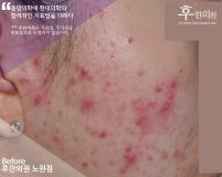 치료 전