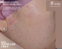 치료 후