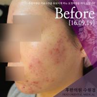 치료 전