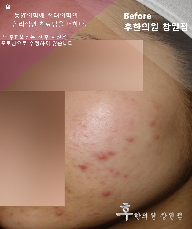 치료 전