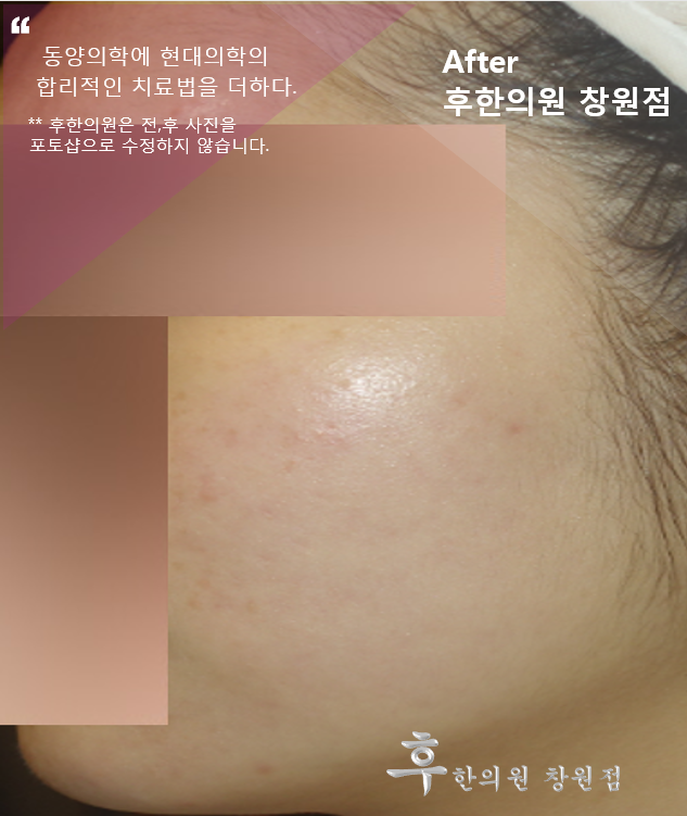 치료 후