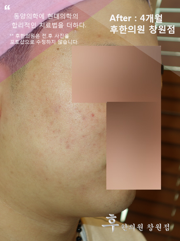 치료 후